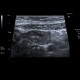 Acute colitis, inflammatory lymph nodes: US - Ultrasound